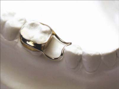 兒(er) 童缺牙做間隙保持