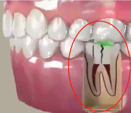 根管治療後牙齒折裂