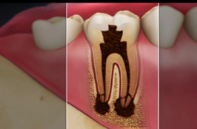 壞到牙根周圍組織