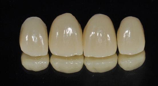 威蘭(lan) 德全瓷牙