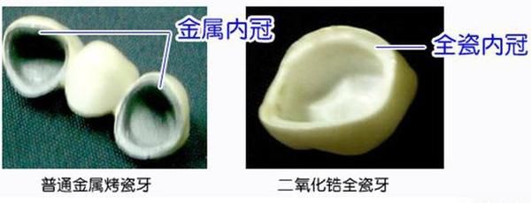 金屬冠和全瓷牙的區別