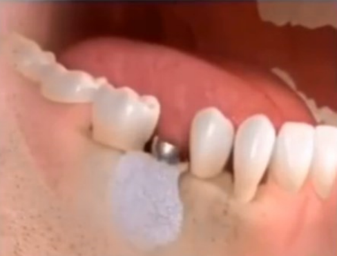 植入骨粉覆蓋骨膜