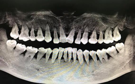 牙槽骨萎縮