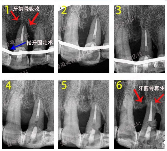 愛康健牙周醫生鬆牙固定術