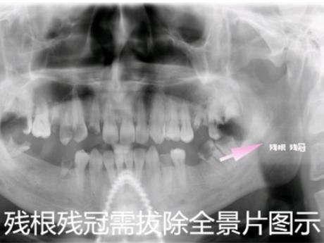 殘根殘冠需要拔除拍片