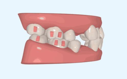 牙齒擁擠常規拔牙