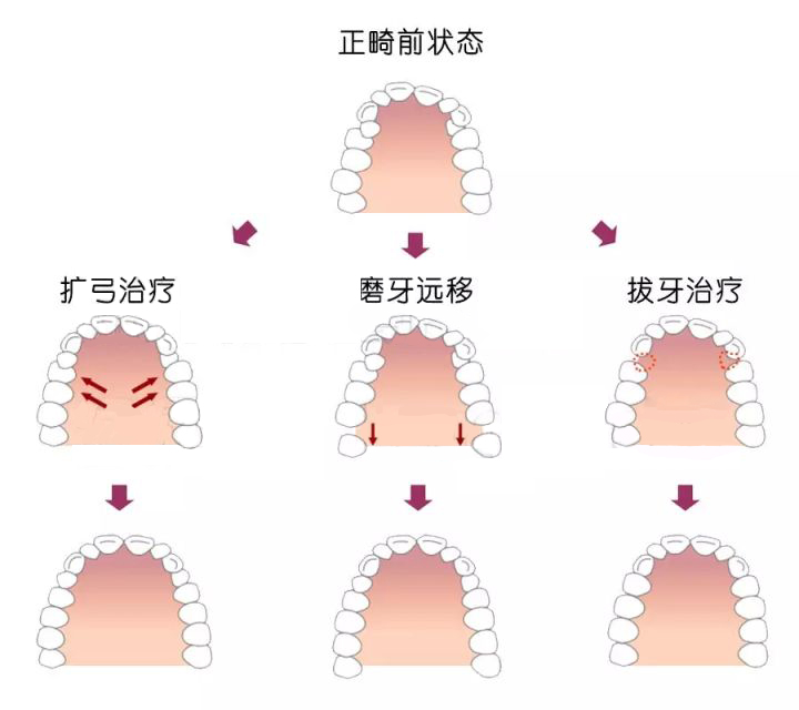 正畸獲得間隙的幾種方式