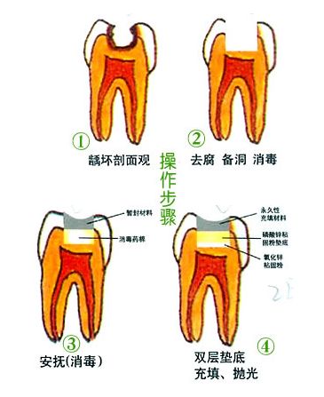 墊底充填補牙