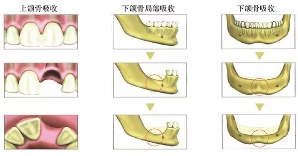 牙槽骨萎縮吸收