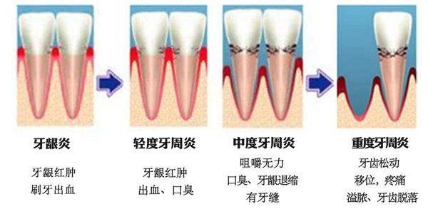 牙周炎的程度
