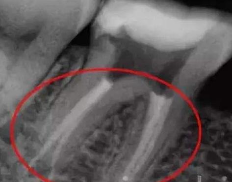 根管治療後拍片