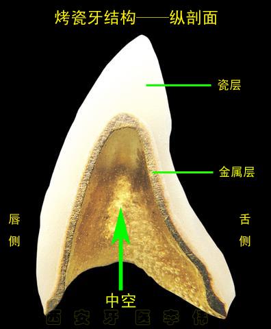 烤瓷牙結構