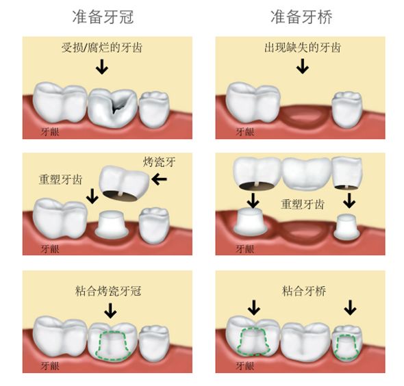 全瓷牙牙冠和烤瓷橋