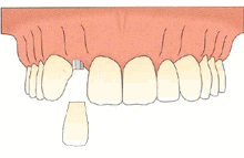 側(ce) 門牙種植牙示意圖