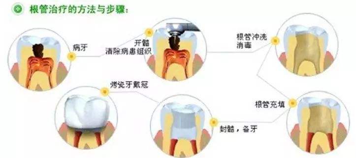根管治療補牙