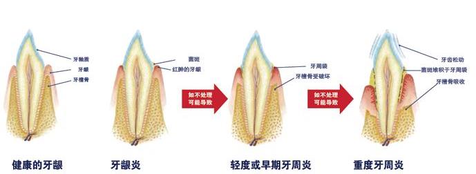 牙周炎的發展