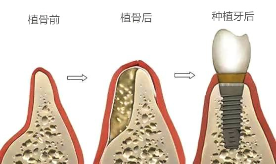 植骨和種植牙