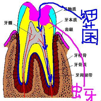 蛀牙細菌