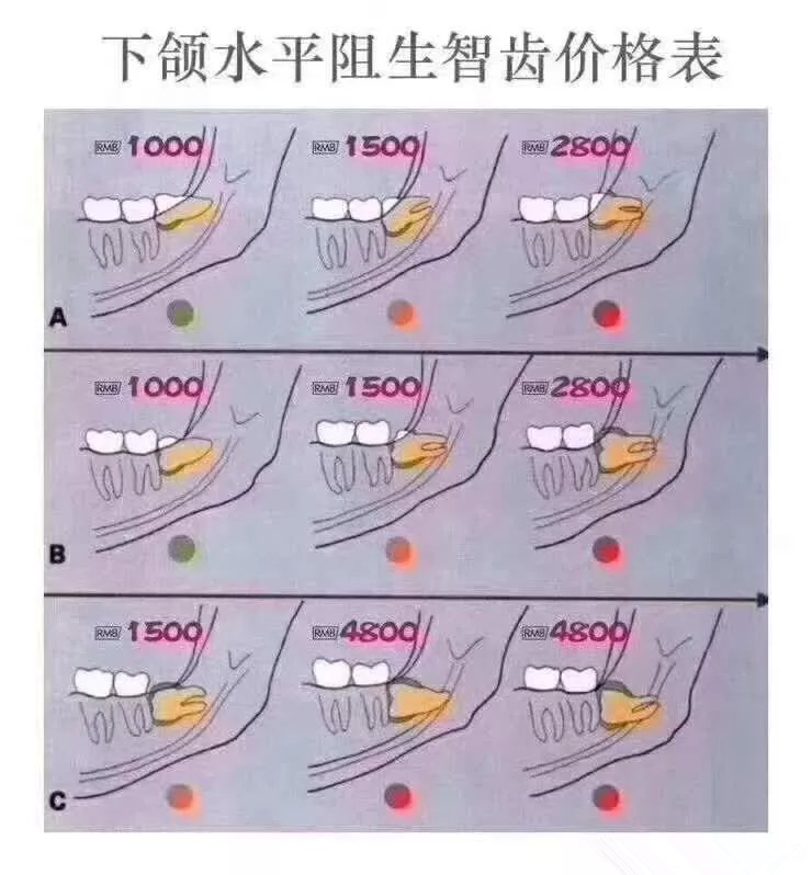 下頜水平阻生價(jia) 格參考