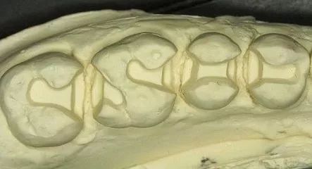 嵌體(ti) 補牙印模