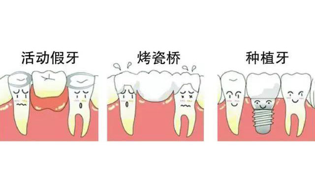 鑲牙三種方式