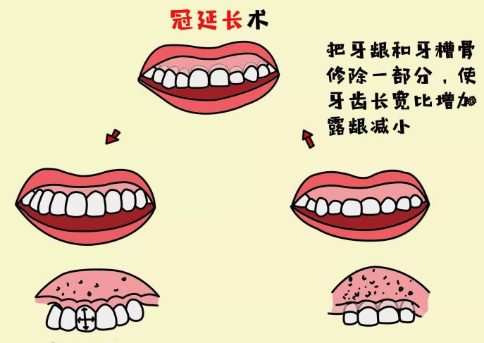 牙冠延長術