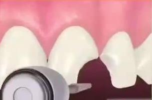 門牙美學修複補牙