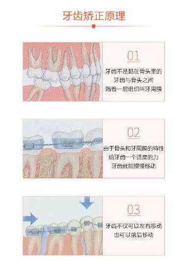 牙齒矯正原理