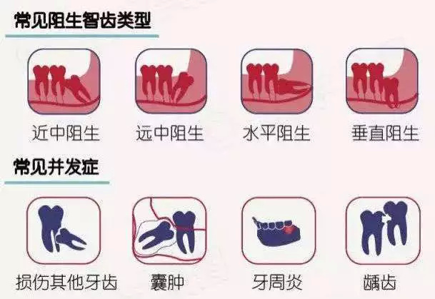 常見智齒類型