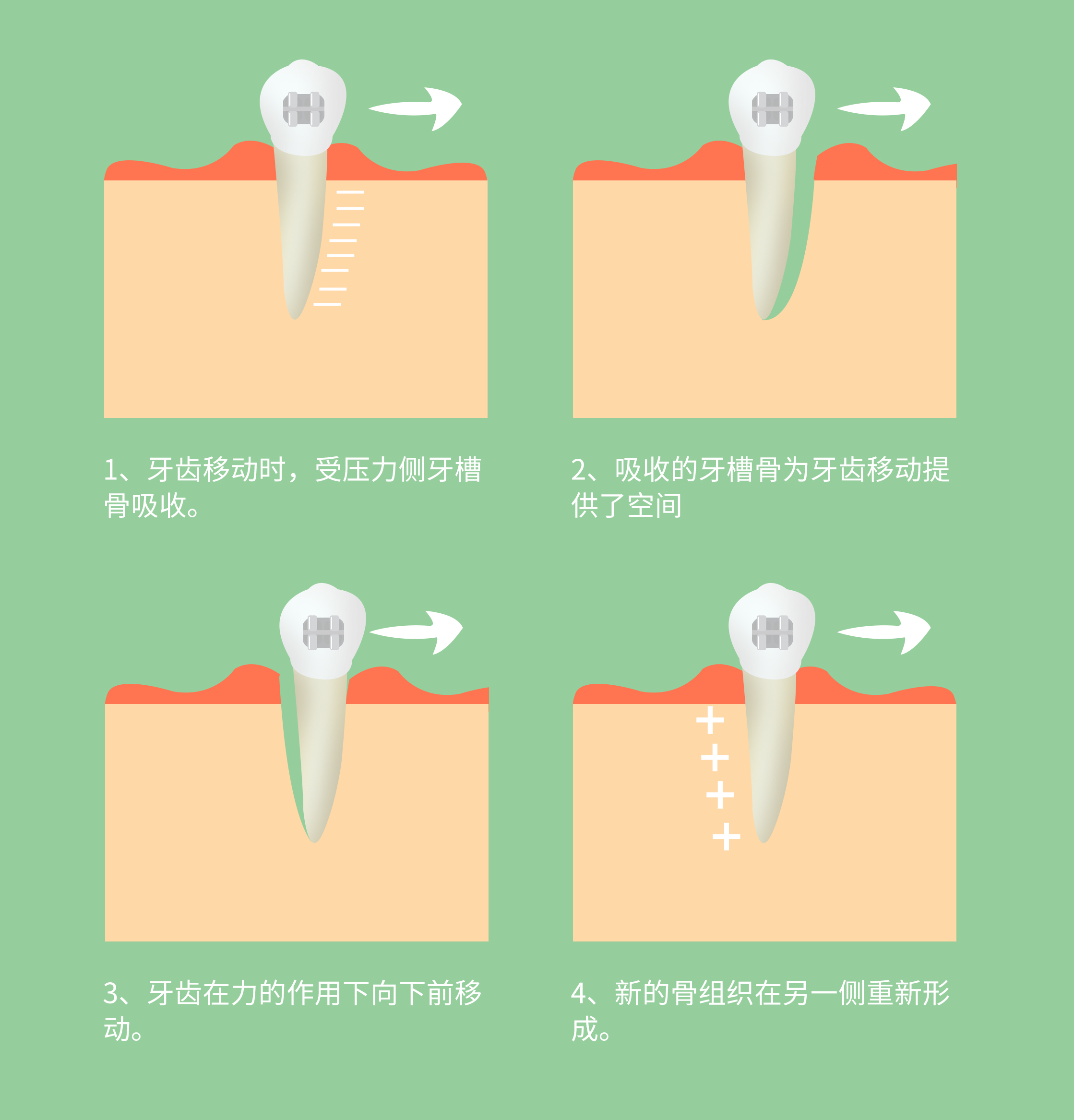牙齒矯正原理
