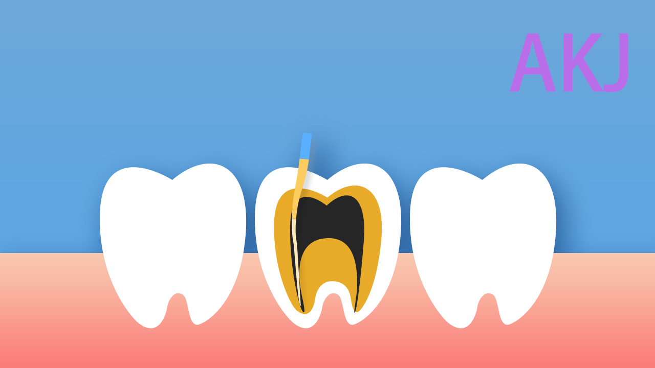 根管治療
