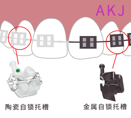 陶瓷自鎖和金屬自鎖