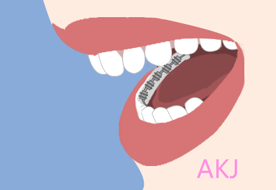 舌側矯正示意圖片