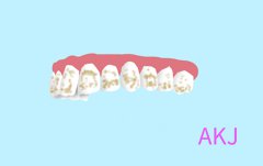 長期使用含氟牙膏，牙齒會不會變成氟斑牙？