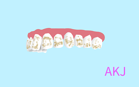 氟斑牙示意圖片