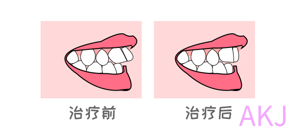 牙齒矯正示意圖片