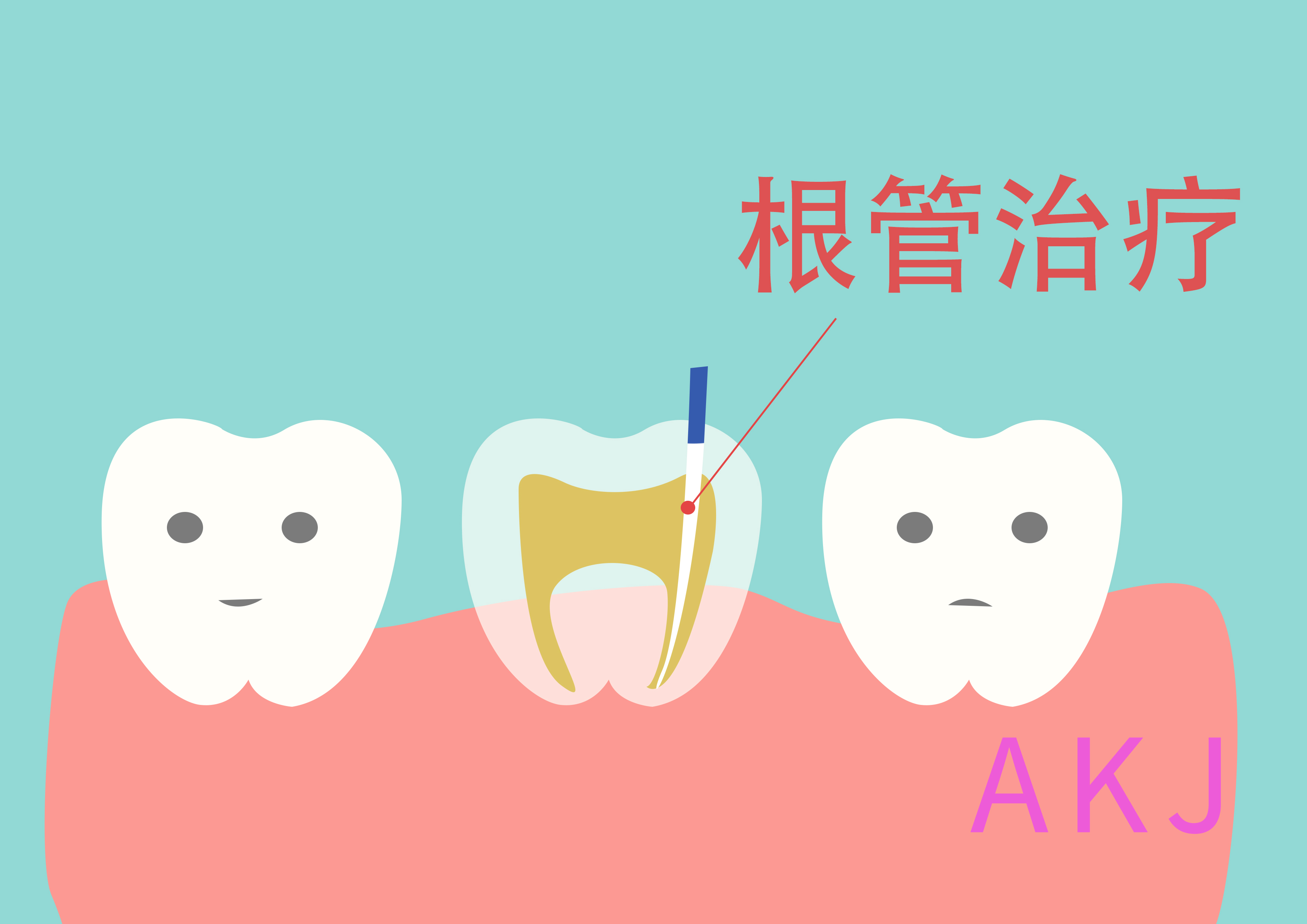 根管治療示意圖片