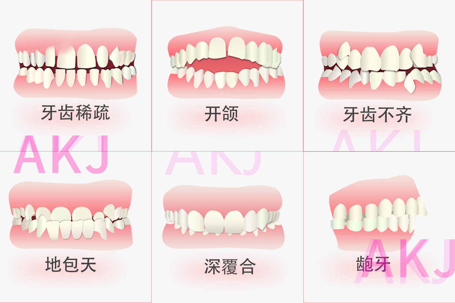 牙齒咬合關(guan) 係示意圖片