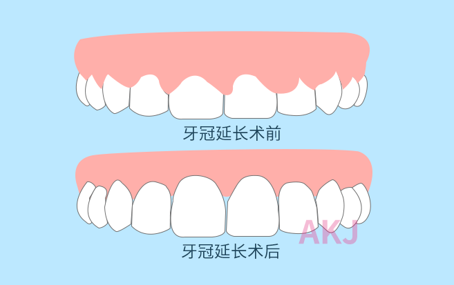 冠延長
