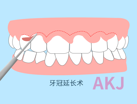 牙冠延長術