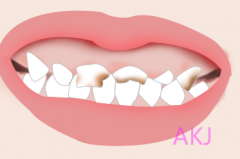 輕度氟斑牙可以通過洗牙治療嗎