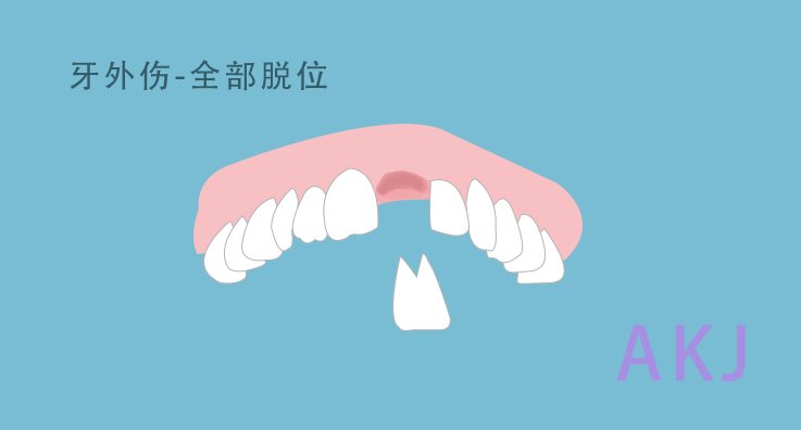 牙外傷(shang) 