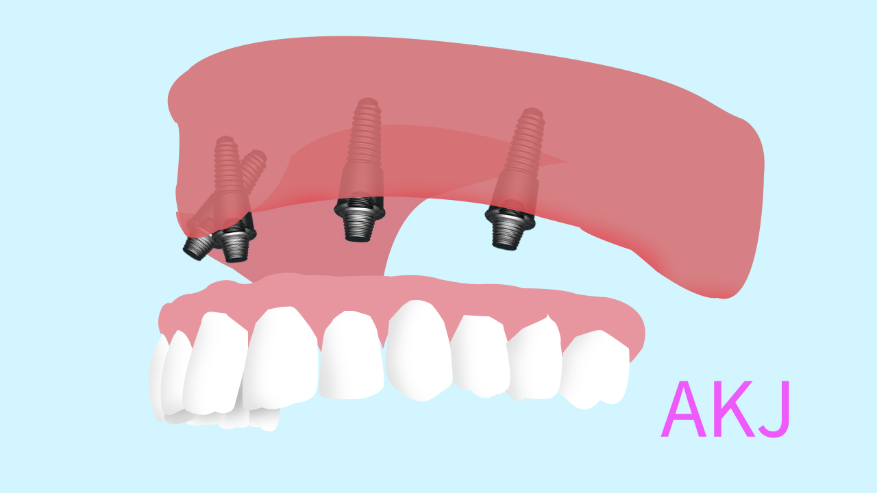 走出種植牙的誤區