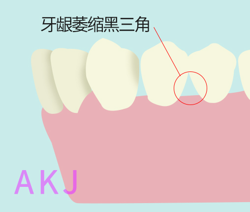牙周炎