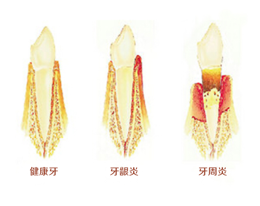 牙周病