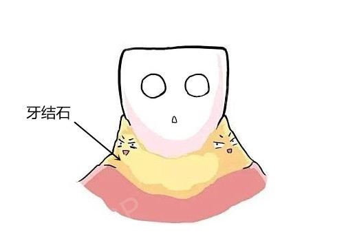 牙結石