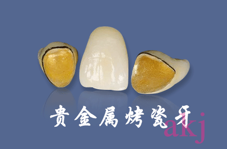 貴金屬烤瓷牙