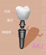 後牙缺失是否可以做種植牙呢