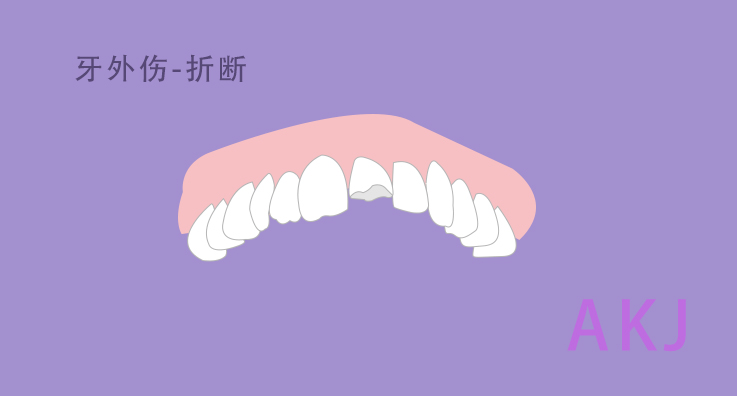 牙外傷(shang) 