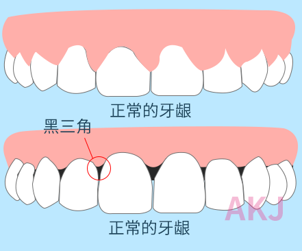 黑三角